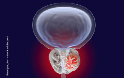 Prostatektomie – Stand der Technik