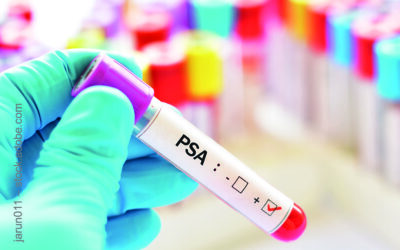 Verzicht auf PSA-Screening in den USA erhöhte Zahl der metastasierten Prostata­karzinome